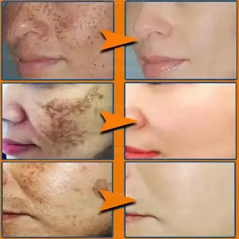 Powerful Whitening Freckles Face Cream Dark Spot Corrector Removal Melasma Fade Melanin Pigmentation Brighten Skin Care Products