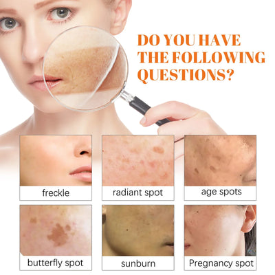 Whitening Freckle Cream Melanin Blemish Remover Lighten Pigmentation Melasma Removal Whiten Nourish Dark Spot Corrector Cream