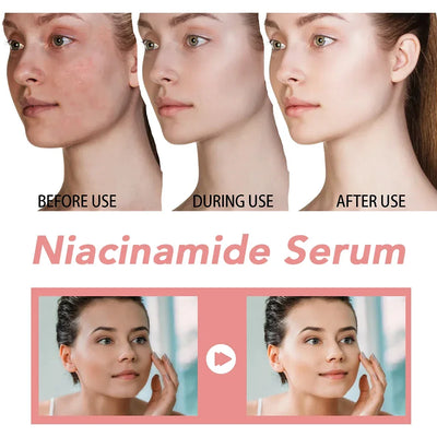 30ml Niacinamide Serum Melanin Removal Fade Melasma Dark Spots Corrector Shrink Pores Hyaluronic Acid Moisturizing Skin Care