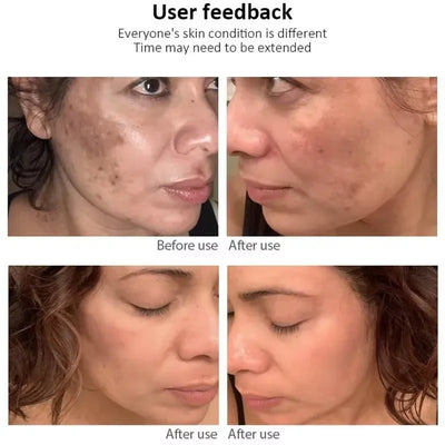 Powerful Whitening Freckles Face Cream Dark Spot Corrector Removal Melasma Fade Melanin Pigmentation Brighten Skin Care Products