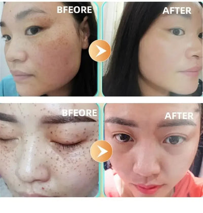Dark Spot Corrector Skin Whitening Fade Cream Lighten Blemish Removal Serum Reduces Freckles Melasma Sun Spot Brighten Skin Care