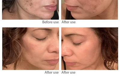 Dark Spot Corrector Skin Whitening Fade Cream Lighten Blemish Removal Serum Reduces Freckles Melasma Sun Spot Brighten Skin Care