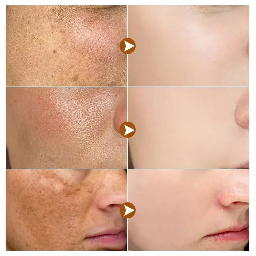 Powerful Whitening Freckles Face Cream Dark Spot Corrector Removal Melasma Fade Melanin Pigmentation Brighten Skin Care Products