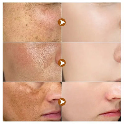 Powerful Whitening Freckles Face Cream Dark Spot Corrector Removal Melasma Fade Melanin Pigmentation Brighten Skin Care Products