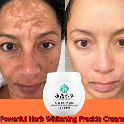Dark Spot Corrector Skin Whitening Fade Cream Lighten Blemish Removal Serum Reduces Freckles Melasma Sun Spot Brighten Skin Care