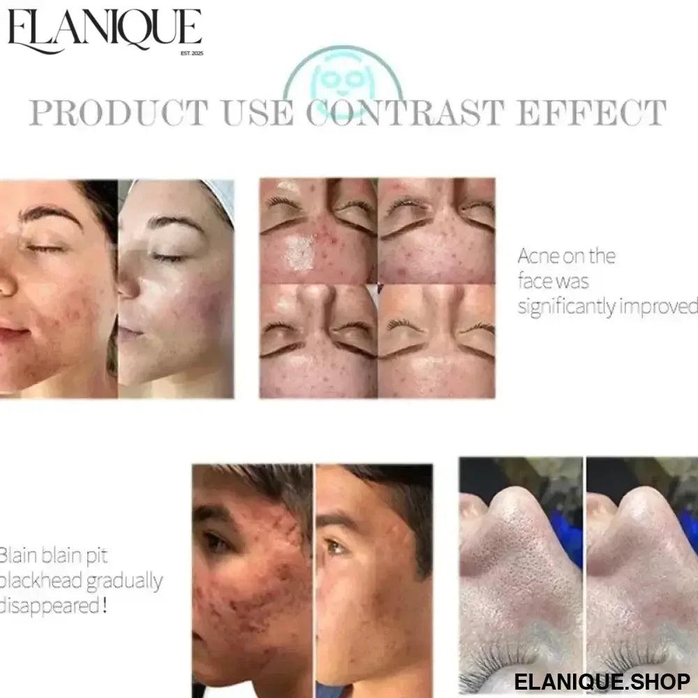 Professional 6 In 1 Water Oxygen Skin Care Deep Cleaning Dermabrasion Facial Machine Water Aqua Peeling - Elanique